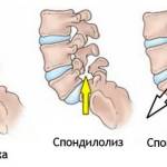 Сместились диски болит спина что делать