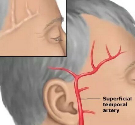 болит правый висок головы неделю