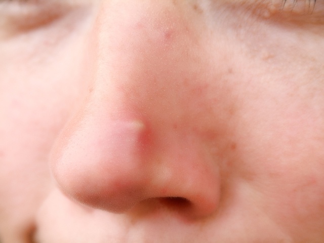 заложен нос и болит голова аллергия