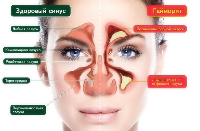 заложен нос и болит голова аллергия