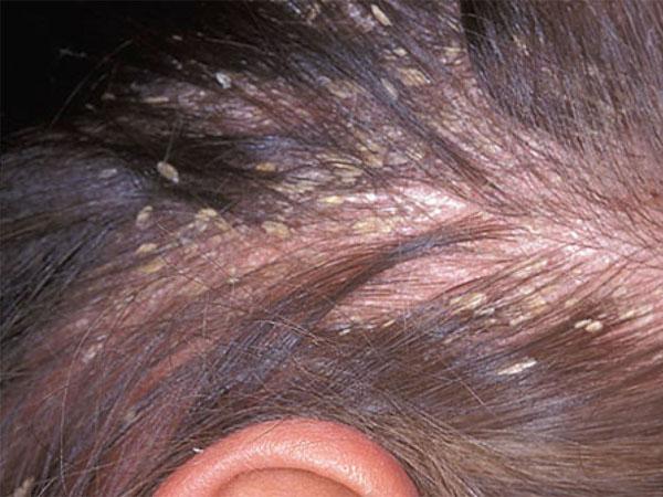 Болячка на голове очень болит