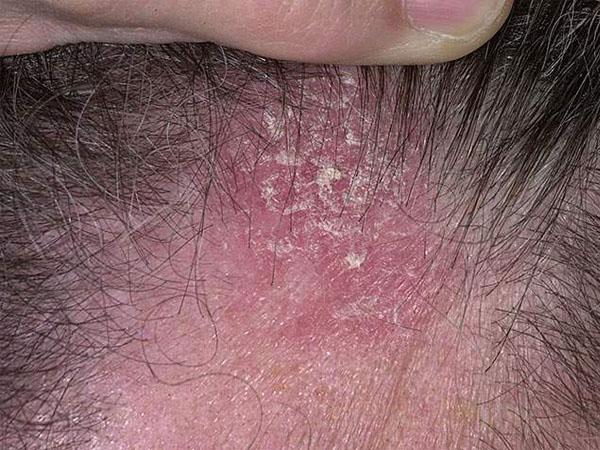 Болячка на голове очень болит