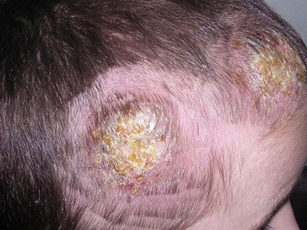 Болячка на голове очень болит