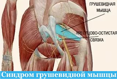 Синдром грушевидной мышцы
