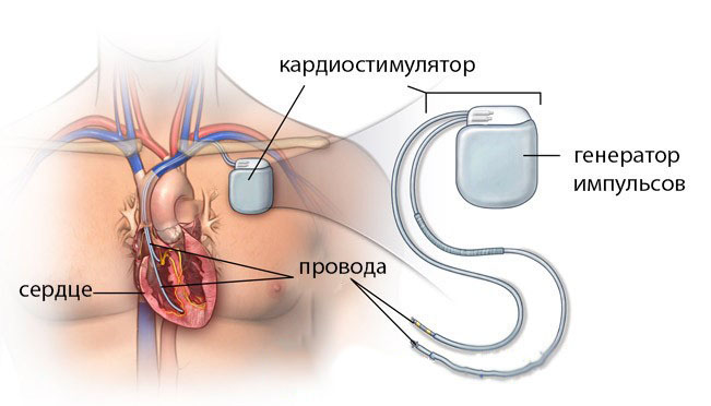 При наличии кардиостимулятора магнитная терапия противопоказана