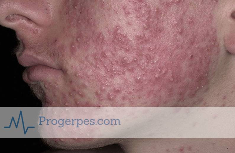 гнойные прыщи ветрянка ветрянка гнойные прыщи