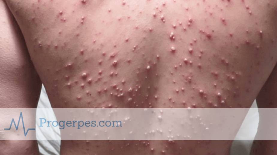 при ветрянке гнойники ветрянка у взрослых с гнойниками