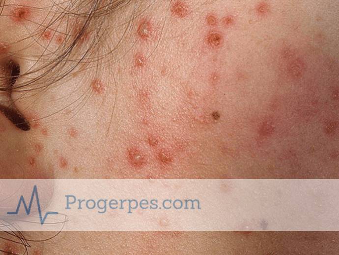 гнойная ветрянка фото ветрянка гнойная фото