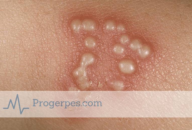 при ветрянке гнойные прыщи гнойные прыщи при ветрянке у взрослых