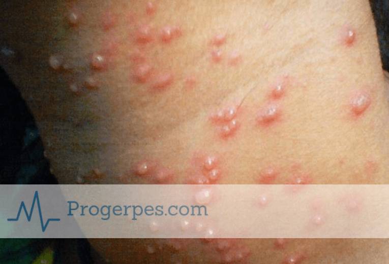ветрянка гнойная фото гнойная ветрянка у взрослых