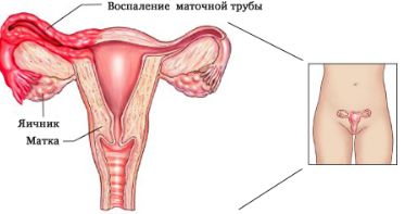 от чего может болеть спина после месячных