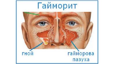 Температура болит спина ноги
