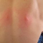 Пятно на спине чешется болит