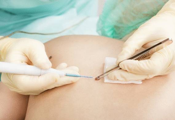 болит родинка