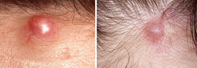 Эпидермальная киста на голове