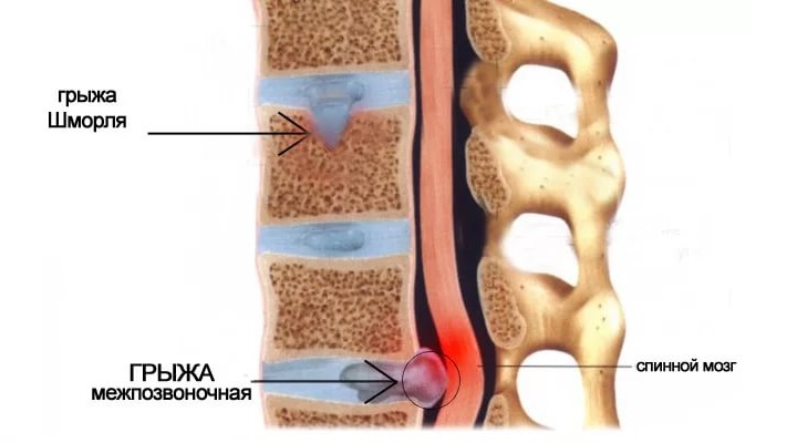 Магнитотерапия показана при грыжах позвоночника