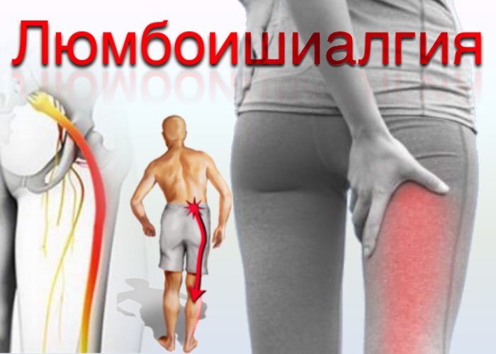 При люмбоишиалгии боль отдает в ногу