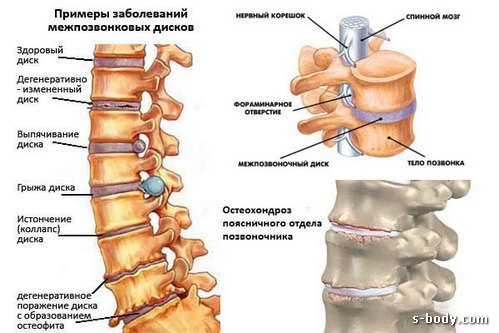 спина болит после приседа