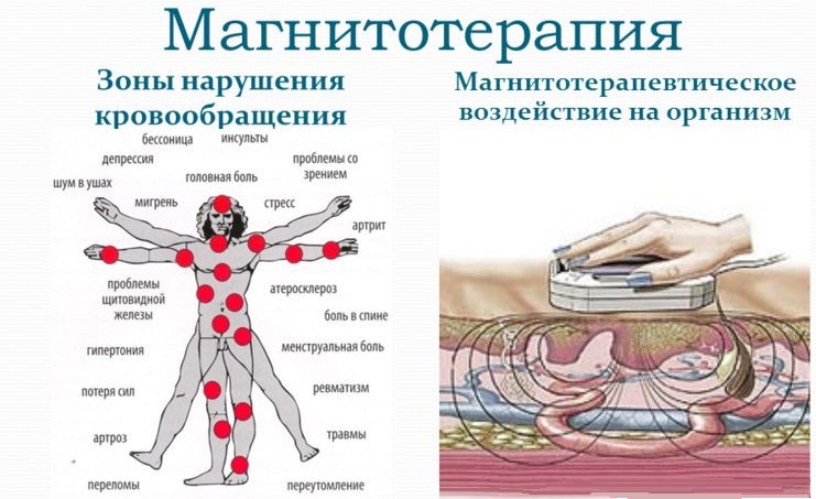 Магнитотерапия оказывает комплексное воздействие на организм