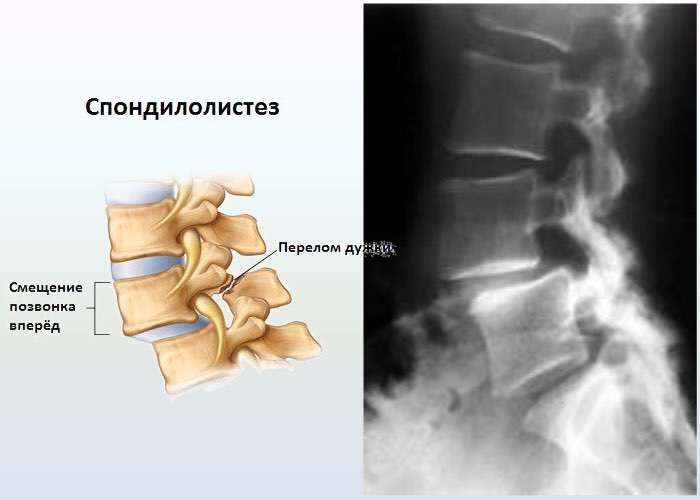 Спондилолистез - что это