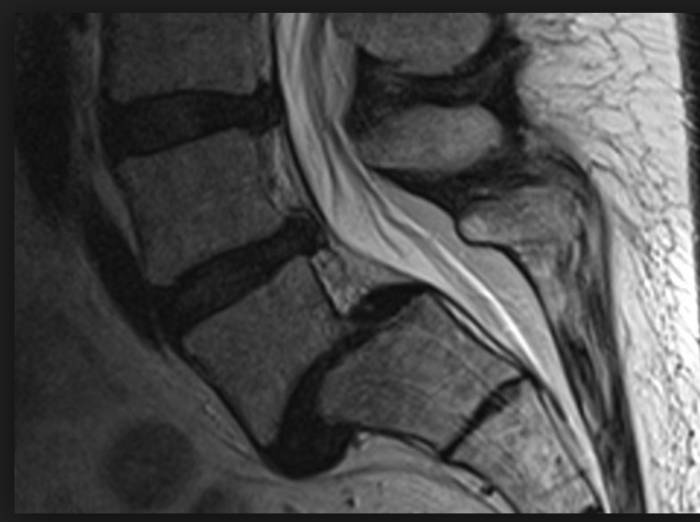 Спондилолистез на МРТ