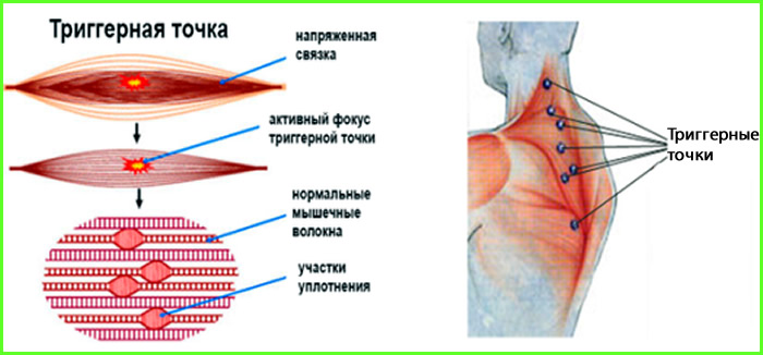 Триггерные точки