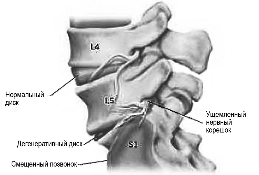 Ущемленный нервный корешок