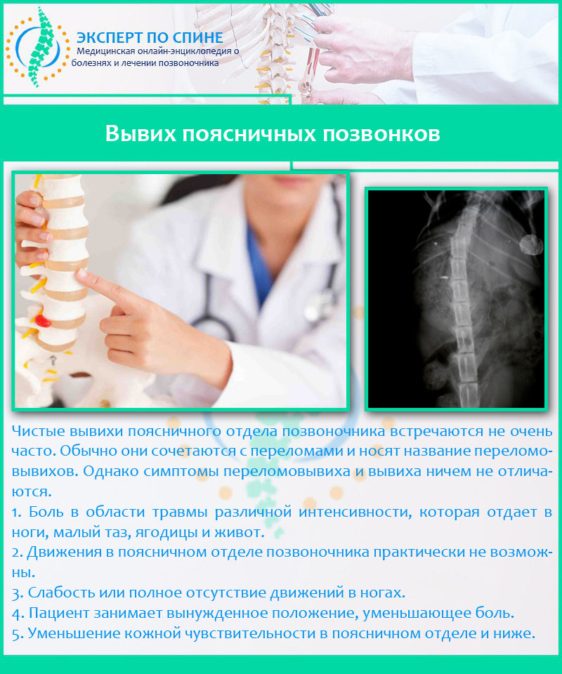 Вывих поясничных позвонков